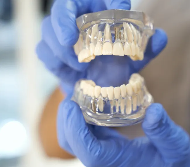Understanding the Cost of Dental Implants