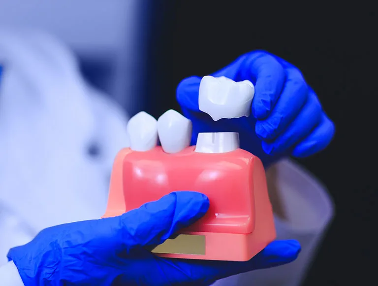 What Are Dental Crowns?