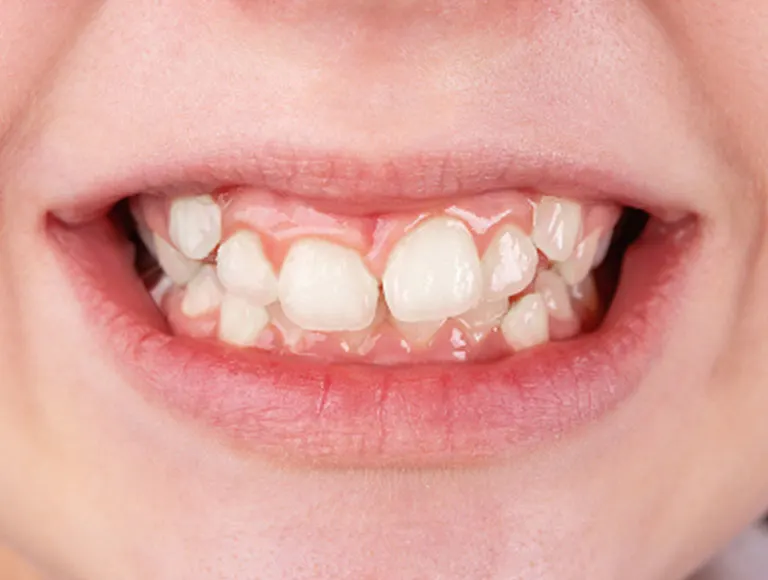 Crowded Teeth