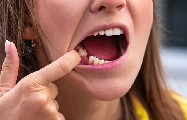 Woman showing a missing tooth