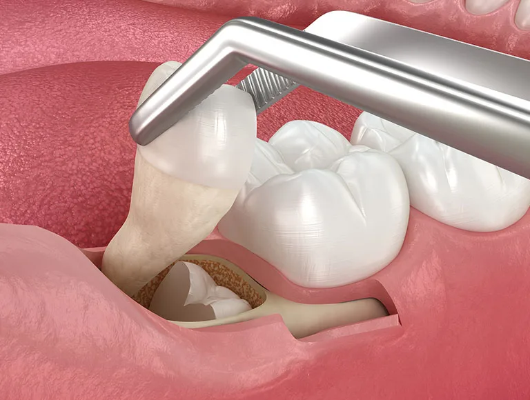 Fast Relief for Troublesome Teeth