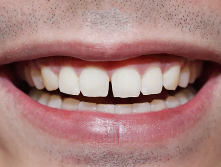 Gaps Between Teeth
