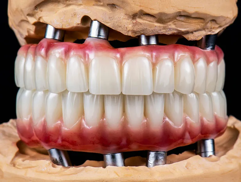 Full Mouth Reconstruction