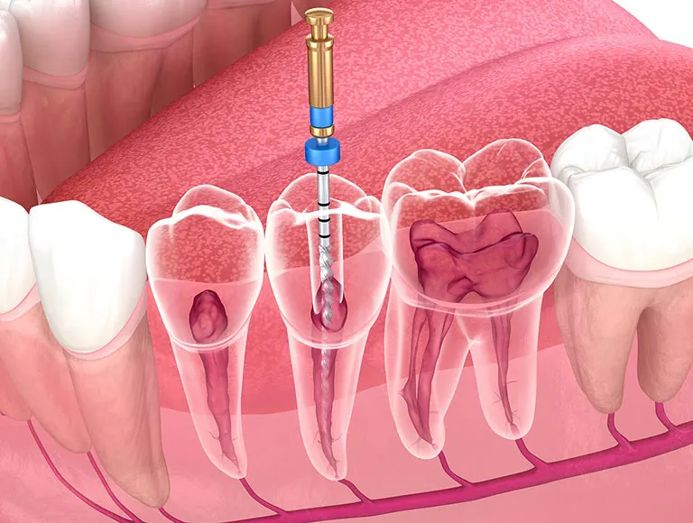 Someone Need a Root Canal