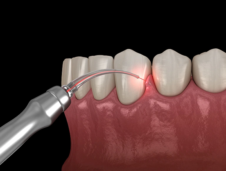 Hand holding soft tissue laser hand tool