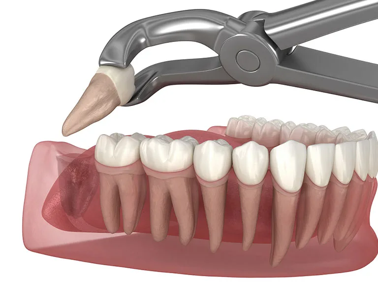 Stress-Free Tooth Removal