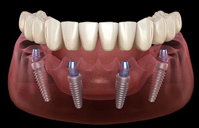 Digital image of an implant denture