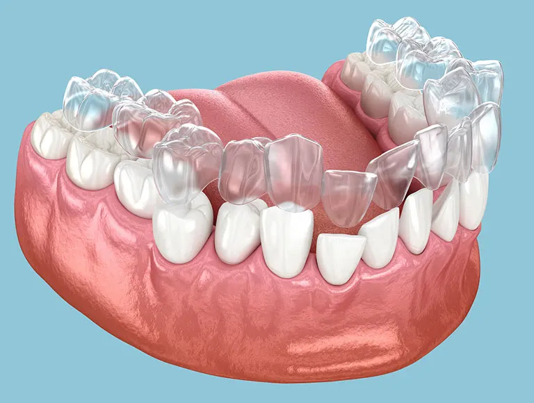 Understanding the Cost of Invisalign
