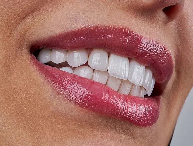 What Is Dental Bonding?