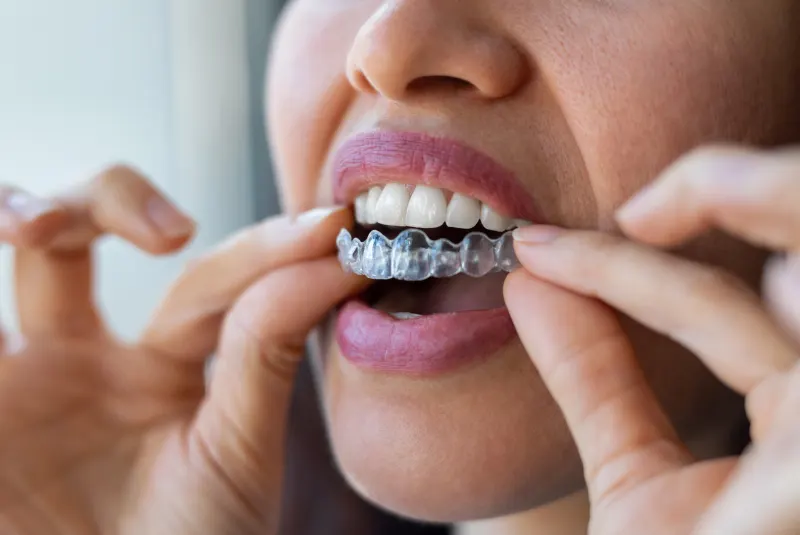 Who benefits from Invisalign®?
