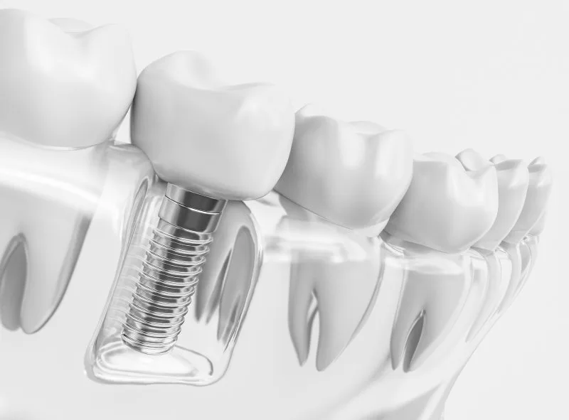 dental implant diagram