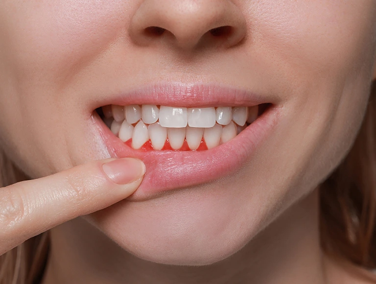 Conservative Care For Gum Disease